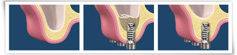 Sinus Augmentation – Levenson Periodontal Associates