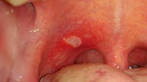 Canker Sores Levenson Periodontal Associates